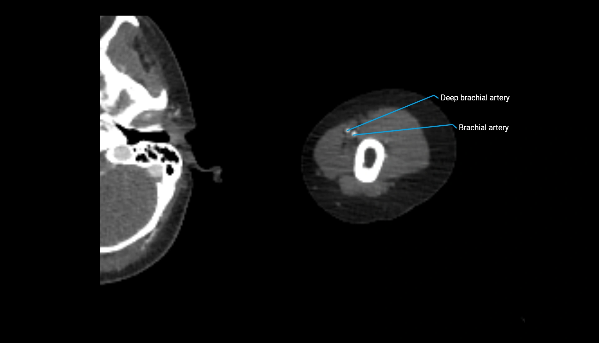 CTA upper limb axial cross sectional anatomy labelled image 264 (2).webp